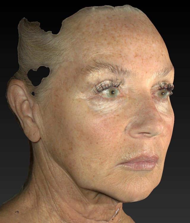 Microneedling before at Healthylooks Med Spa & Wellness in Lee's Summit, MO
