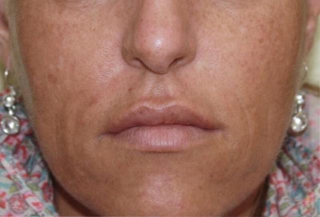 Lip Filler after at Healthylooks Med Spa & Wellness in Lee's Summit, MO