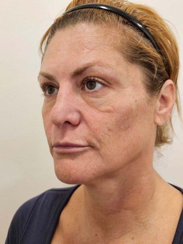 Juvederm after at Healthylooks Med Spa & Wellness in Lee's Summit, MO