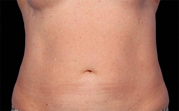 CoolSculpting after at Healthylooks Med Spa & Wellness in Lee's Summit, MO