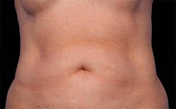 CoolSculpting before at Healthylooks Med Spa & Wellness in Lee's Summit, MO