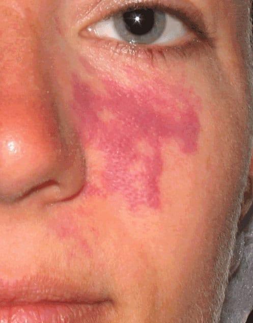Liquid BBL before at Healthylooks Med Spa & Wellness in Lee's Summit, MO