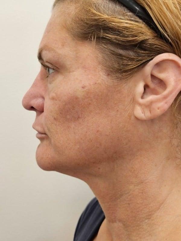 Healthylooks Med Spa & Wellness cheek filler after — Lee's Summit, MO
