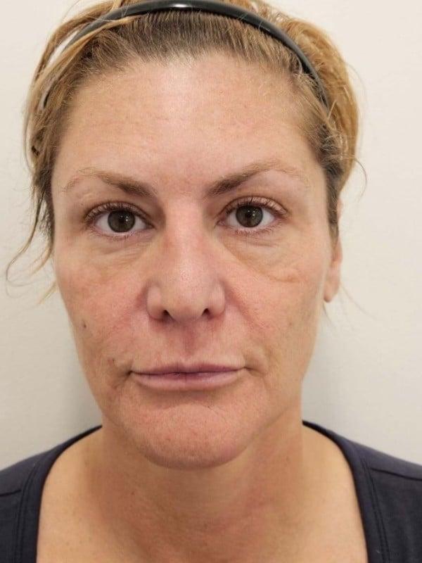 Juvederm after at Healthylooks Med Spa & Wellness in Lee's Summit, MO