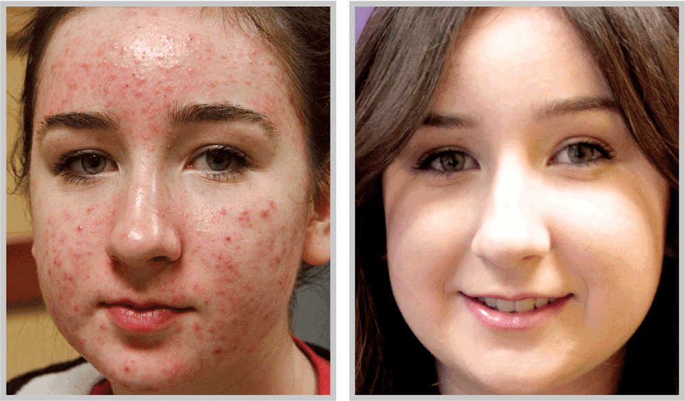 Healthylooks Med Spa & Wellness bbl result — Lee's Summit, MO