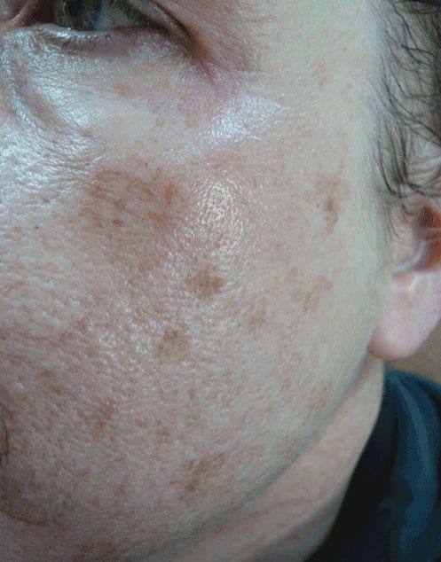 Liquid BBL before at Healthylooks Med Spa & Wellness in Lee's Summit, MO
