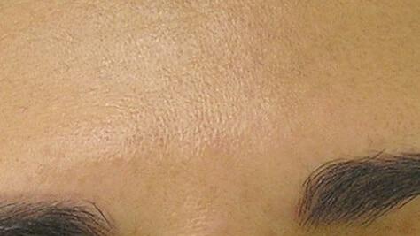 Chemical Peel after at Healthylooks Med Spa & Wellness in Lee's Summit, MO