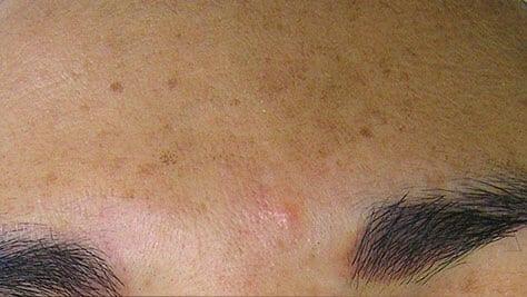 Chemical Peel before at Healthylooks Med Spa & Wellness in Lee's Summit, MO