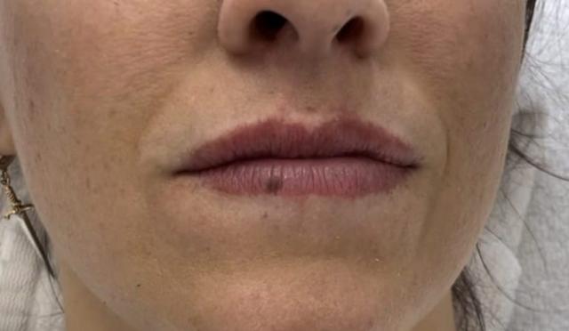 Lip Filler before at Healthylooks Med Spa & Wellness in Lee's Summit, MO
