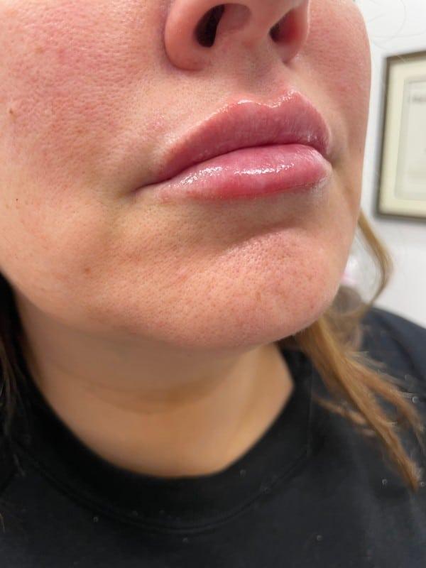 Healthylooks Med Spa & Wellness lip filler after — Lee's Summit, MO