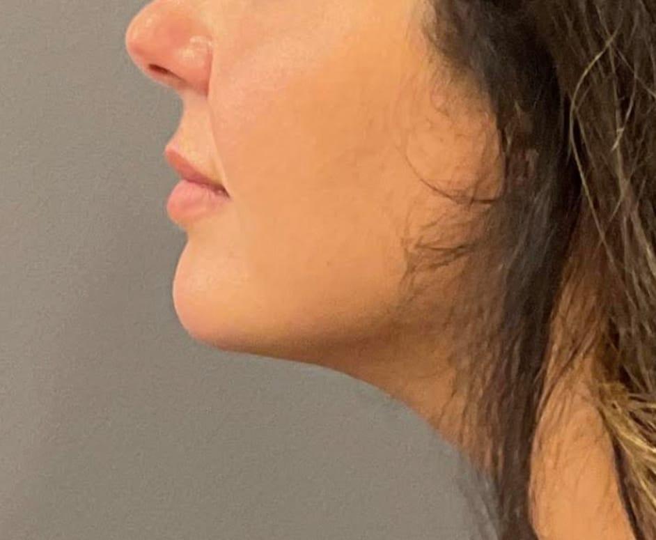 Healthylooks Med Spa & Wellness coolsculpting after — Lee's Summit, MO