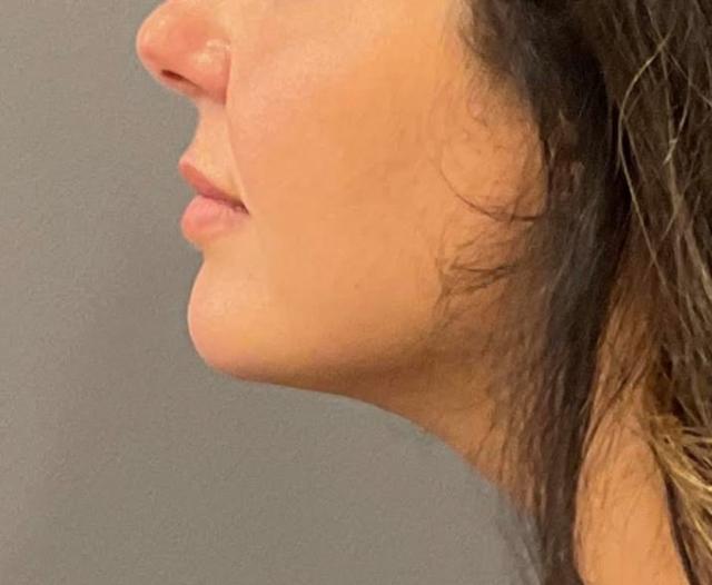 Arm Lift after at Healthylooks Med Spa & Wellness in Lee's Summit, MO