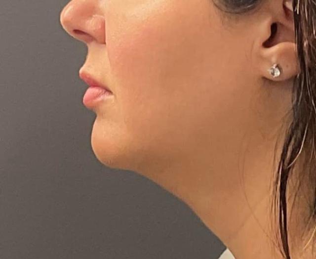 Arm Lift before at Healthylooks Med Spa & Wellness in Lee's Summit, MO