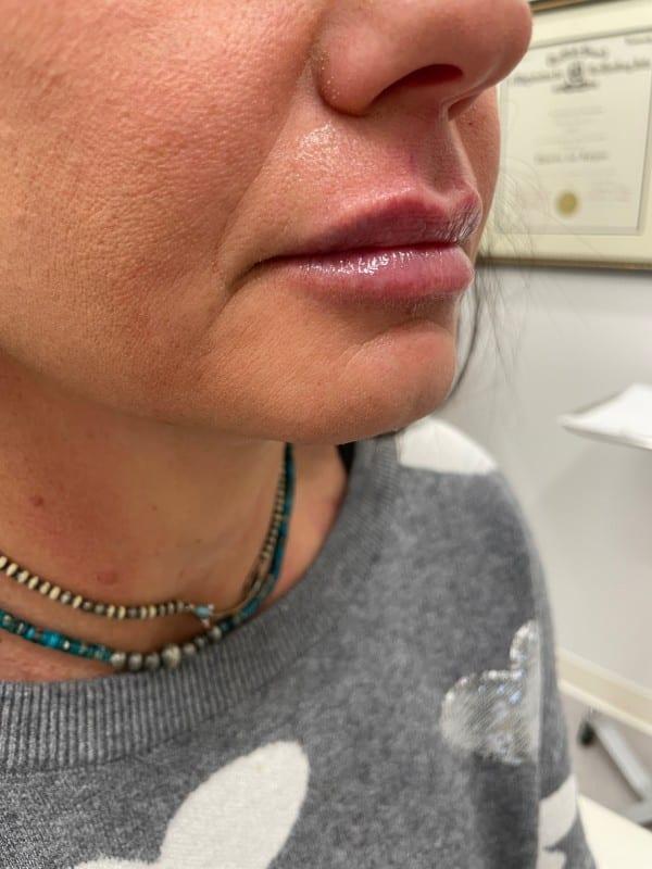 Healthylooks Med Spa & Wellness lip filler after — Lee's Summit, MO