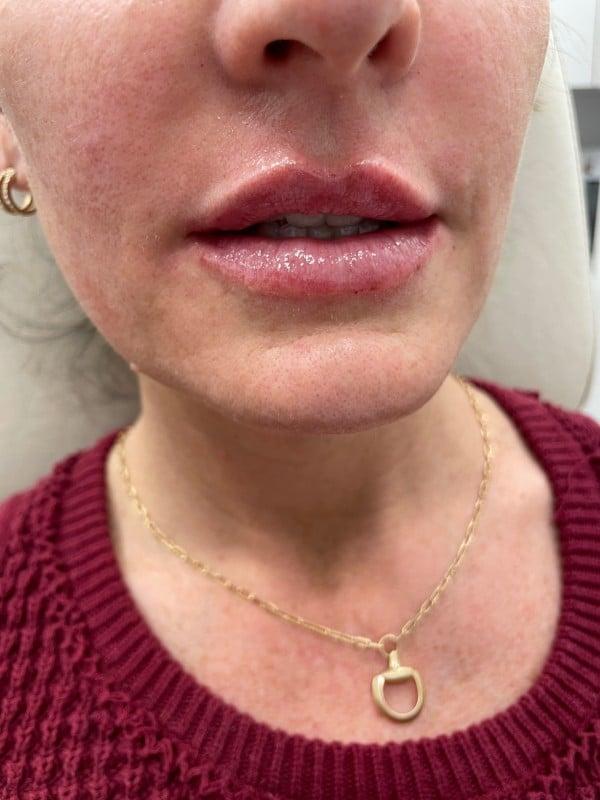 Healthylooks Med Spa & Wellness lip filler after — Lee's Summit, MO