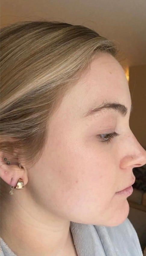 Morpheus8 after at Healthylooks Med Spa & Wellness in Lee's Summit, MO