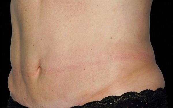 Tummy Tuck after at Healthylooks Med Spa & Wellness in Lee's Summit, MO