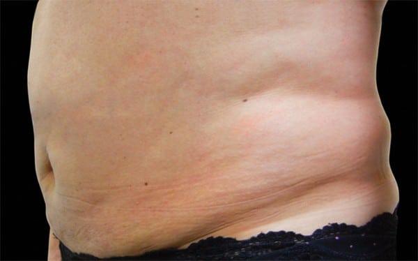 Tummy Tuck before at Healthylooks Med Spa & Wellness in Lee's Summit, MO