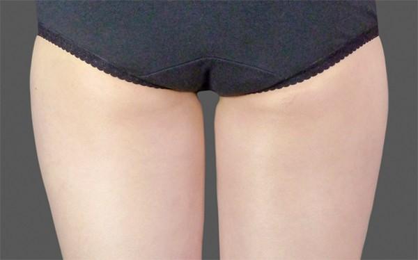 Liposuction after at Healthylooks Med Spa & Wellness in Lee's Summit, MO