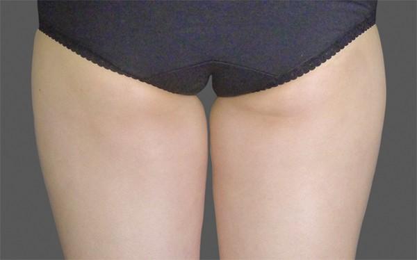 Liposuction before at Healthylooks Med Spa & Wellness in Lee's Summit, MO