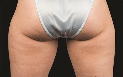 CoolSculpting after at Healthylooks Med Spa & Wellness in Lee's Summit, MO