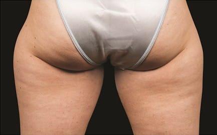 CoolSculpting before at Healthylooks Med Spa & Wellness in Lee's Summit, MO