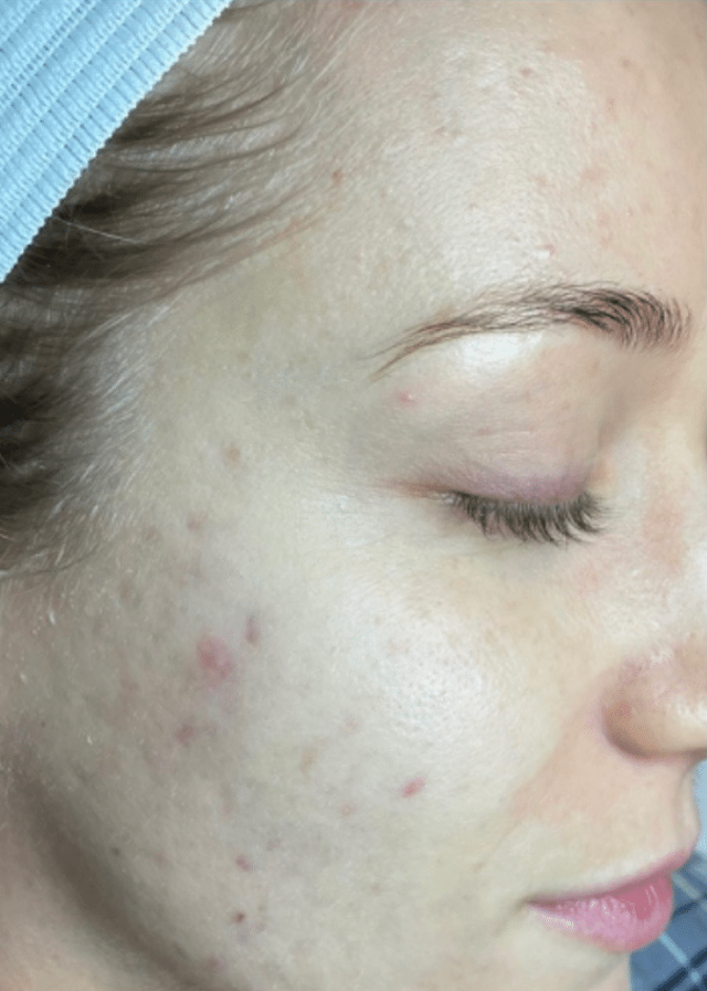 Chemical Peel after at Healthylooks Med Spa & Wellness in Lee's Summit, MO