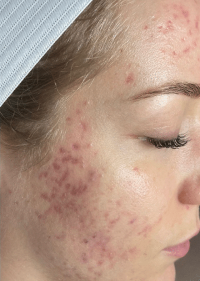 Chemical Peel before at Healthylooks Med Spa & Wellness in Lee's Summit, MO