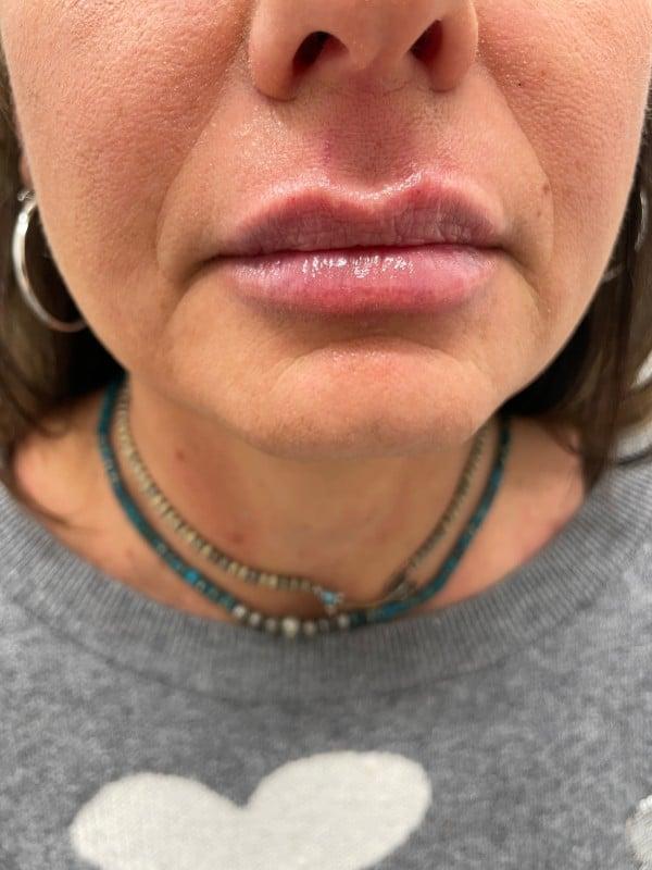 Healthylooks Med Spa & Wellness lip filler after — Lee's Summit, MO