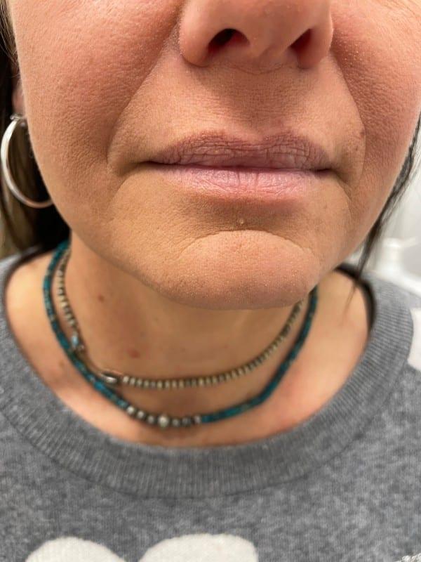 Lip Filler before at Healthylooks Med Spa & Wellness in Lee's Summit, MO