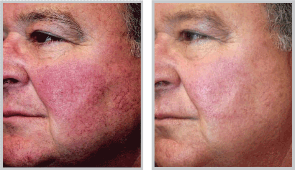 Healthylooks Med Spa & Wellness bbl result — Lee's Summit, MO
