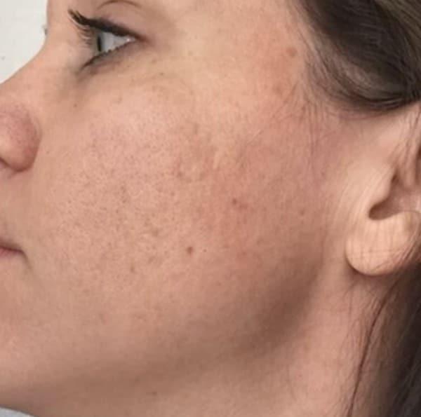 Chemical Peel after at Healthylooks Med Spa & Wellness in Lee's Summit, MO