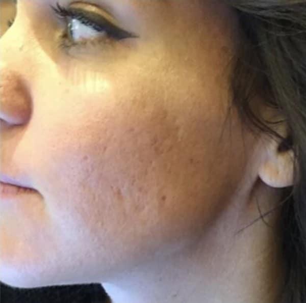 Chemical Peel before at Healthylooks Med Spa & Wellness in Lee's Summit, MO