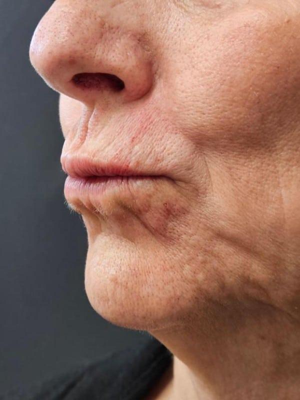 Lip Filler after at Healthylooks Med Spa & Wellness in Lee's Summit, MO