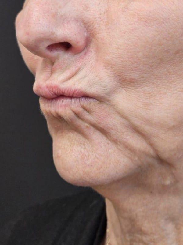 Lip Filler before at Healthylooks Med Spa & Wellness in Lee's Summit, MO