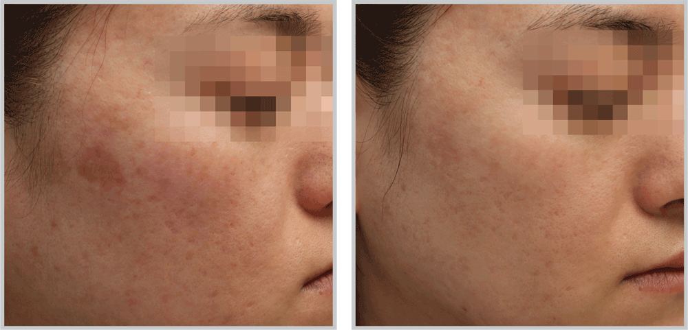 Healthylooks Med Spa & Wellness bbl result — Lee's Summit, MO