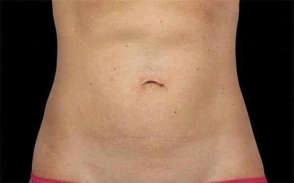 Liposuction after at Healthylooks Med Spa & Wellness in Lee's Summit, MO