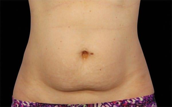 Liposuction before at Healthylooks Med Spa & Wellness in Lee's Summit, MO