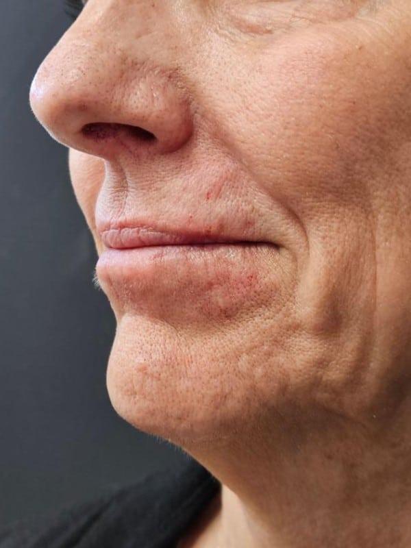 Lip Filler after at Healthylooks Med Spa & Wellness in Lee's Summit, MO