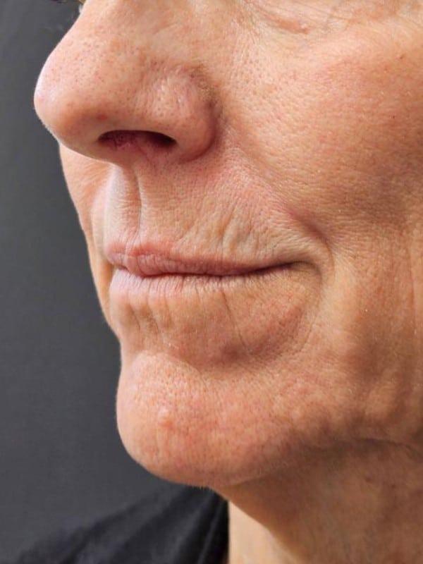 Lip Filler before at Healthylooks Med Spa & Wellness in Lee's Summit, MO