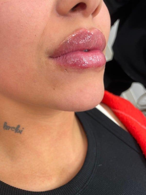 Healthylooks Med Spa & Wellness lip filler after — Lee's Summit, MO