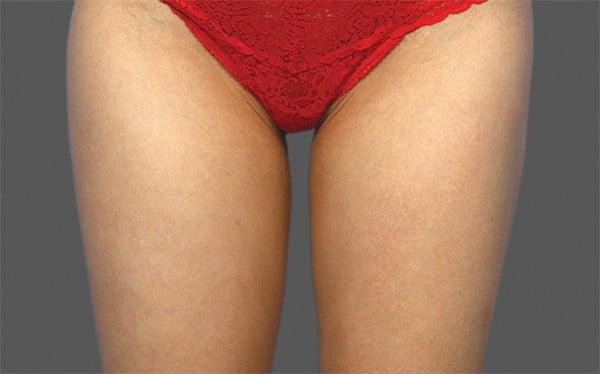 CoolSculpting after at Healthylooks Med Spa & Wellness in Lee's Summit, MO