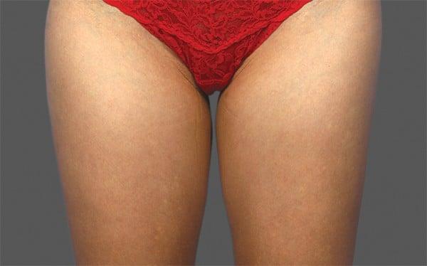CoolSculpting before at Healthylooks Med Spa & Wellness in Lee's Summit, MO