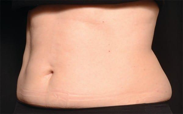 Liposuction after at Healthylooks Med Spa & Wellness in Lee's Summit, MO