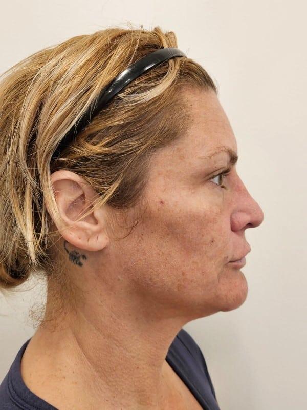 Healthylooks Med Spa & Wellness cheek filler after — Lee's Summit, MO