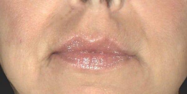 Healthylooks Med Spa & Wellness lip filler after — Lee's Summit, MO