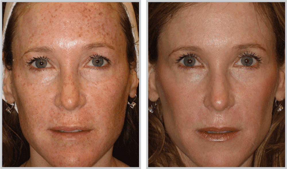 Healthylooks Med Spa & Wellness bbl result — Lee's Summit, MO