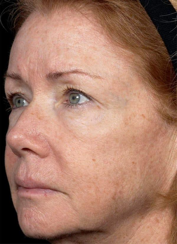 Chemical Peel after at Healthylooks Med Spa & Wellness in Lee's Summit, MO