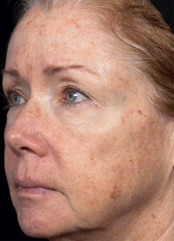 Chemical Peel before at Healthylooks Med Spa & Wellness in Lee's Summit, MO
