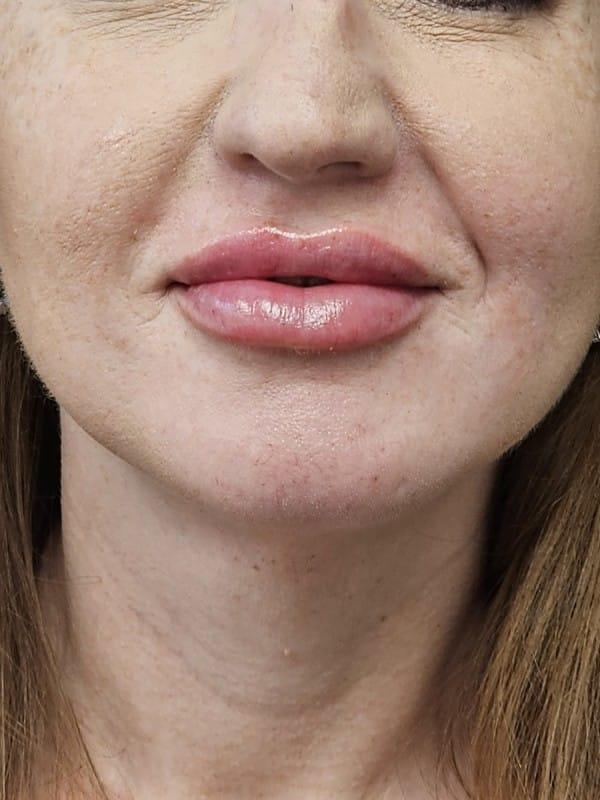 Healthylooks Med Spa & Wellness lip filler after — Lee's Summit, MO